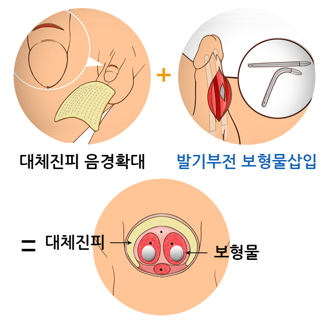 발기부전보형물삽입술